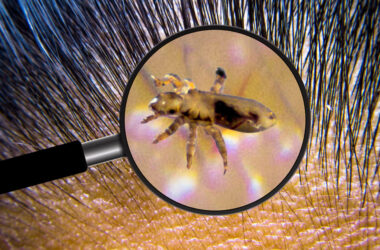 What Are Lice: Meet the Tiny Insects in Your Head